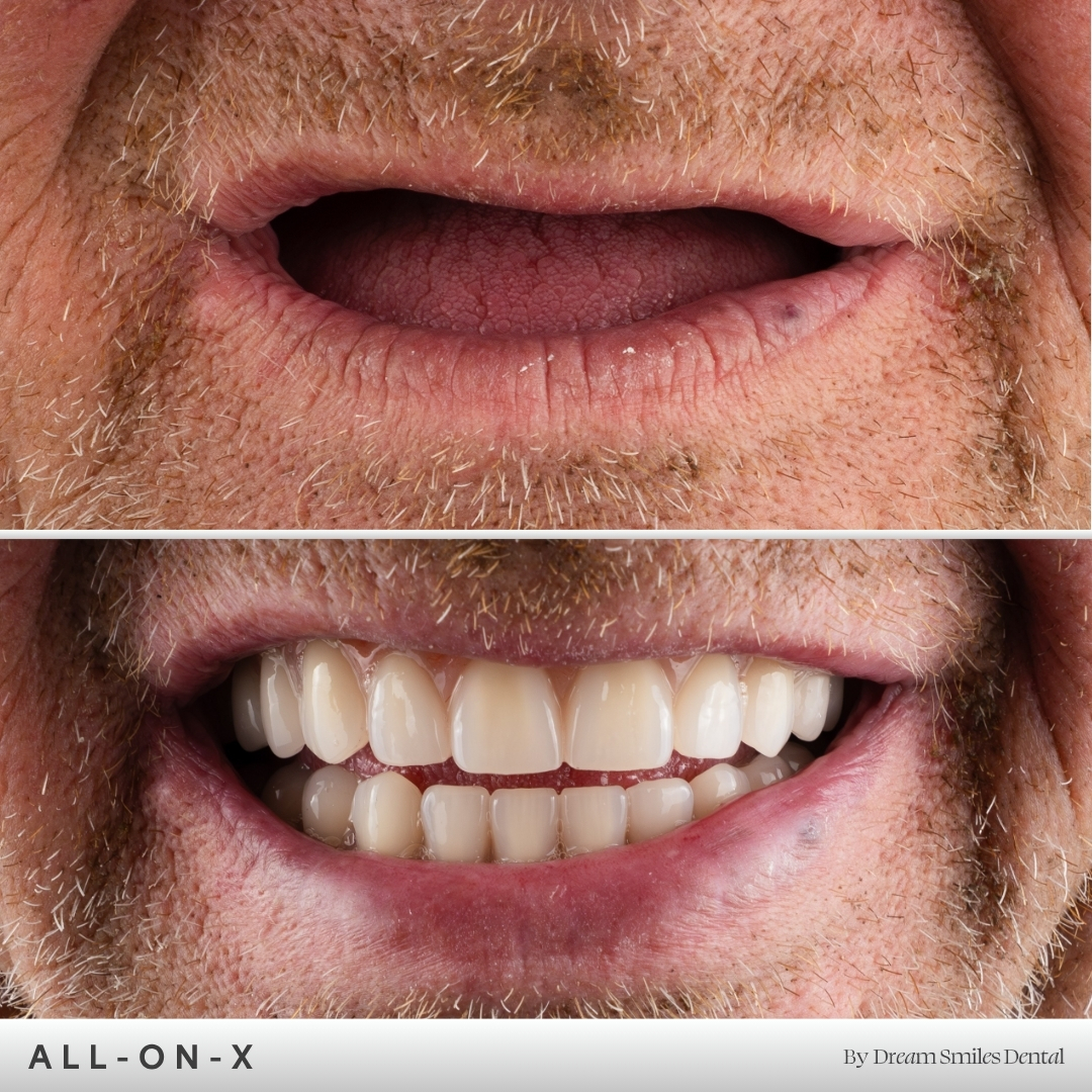 Full arch implant case, before and after