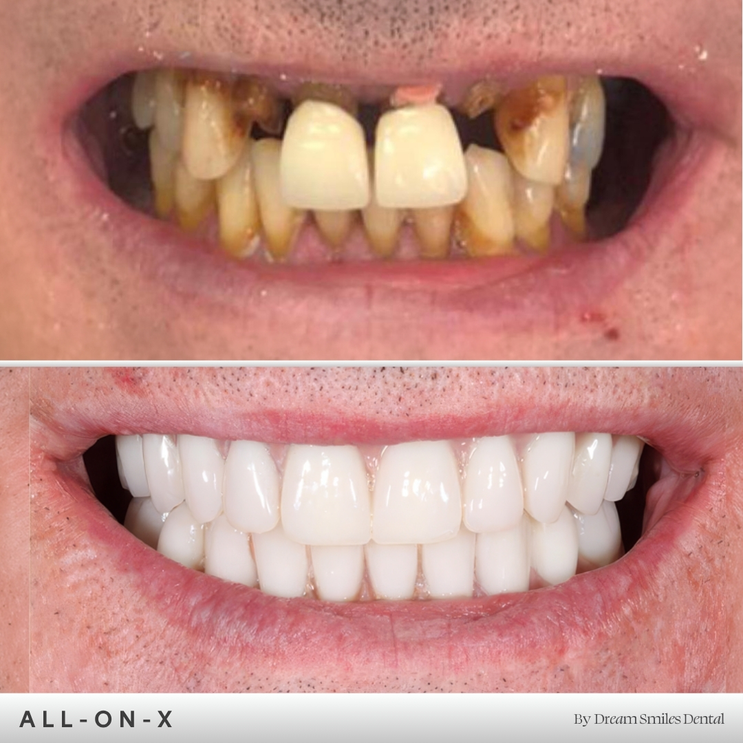Full arch implant case, before and after