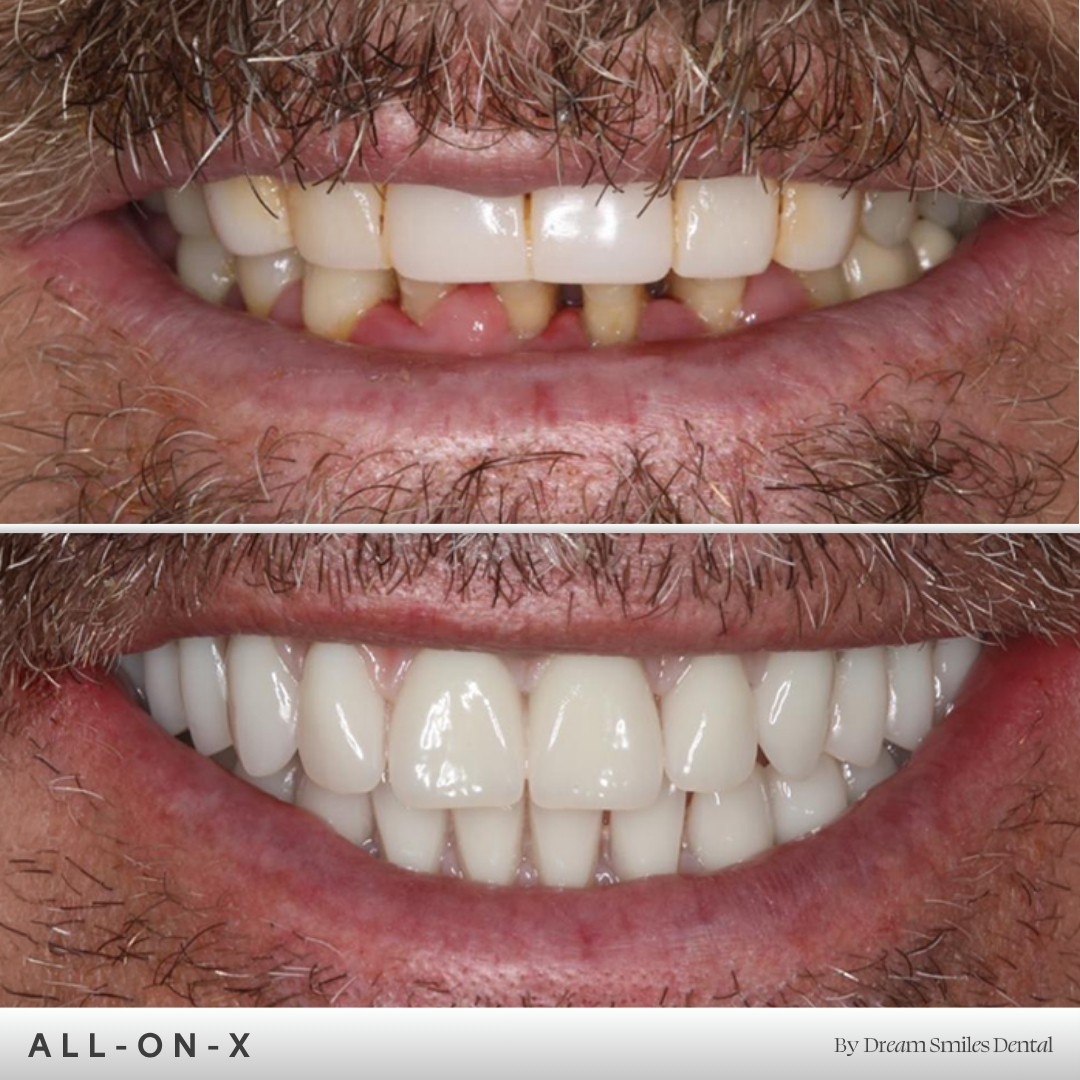 Full arch implant case, before and after