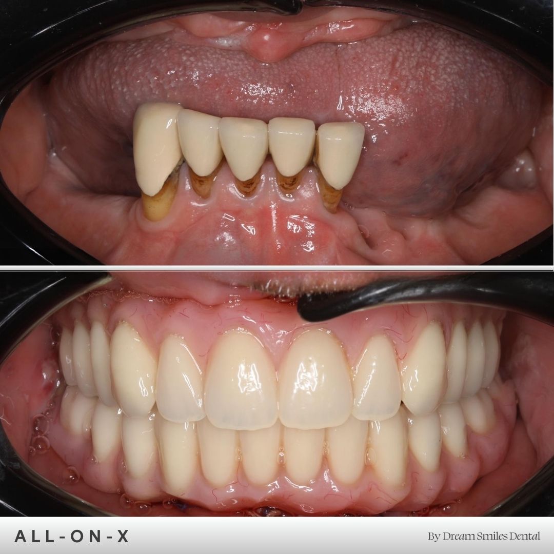 Full arch implant case, before and after
