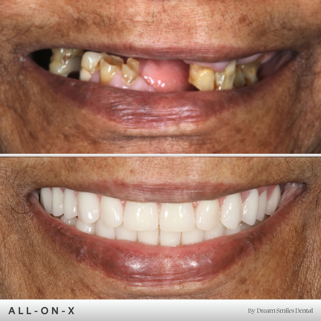 Full arch implant case, before and after