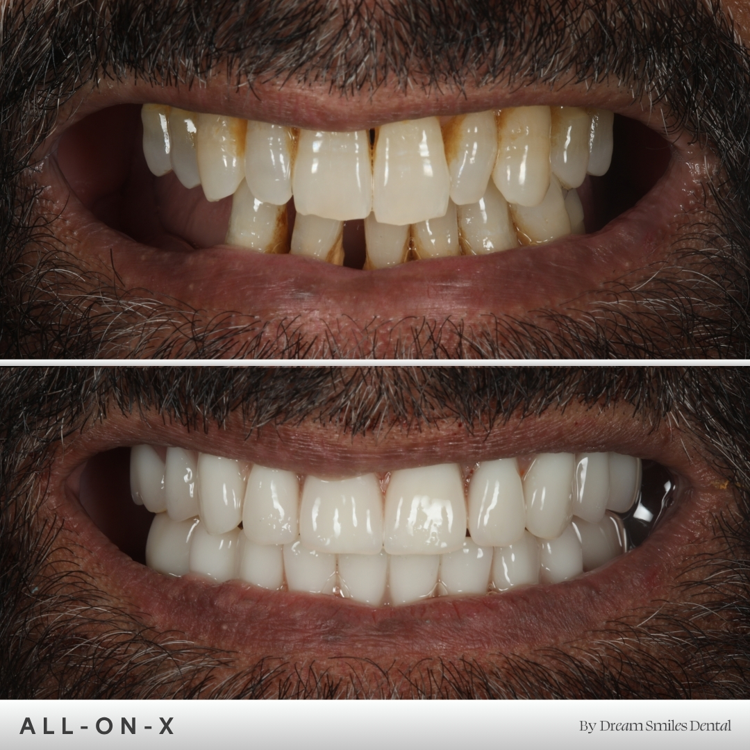 Full arch implant case, before and after