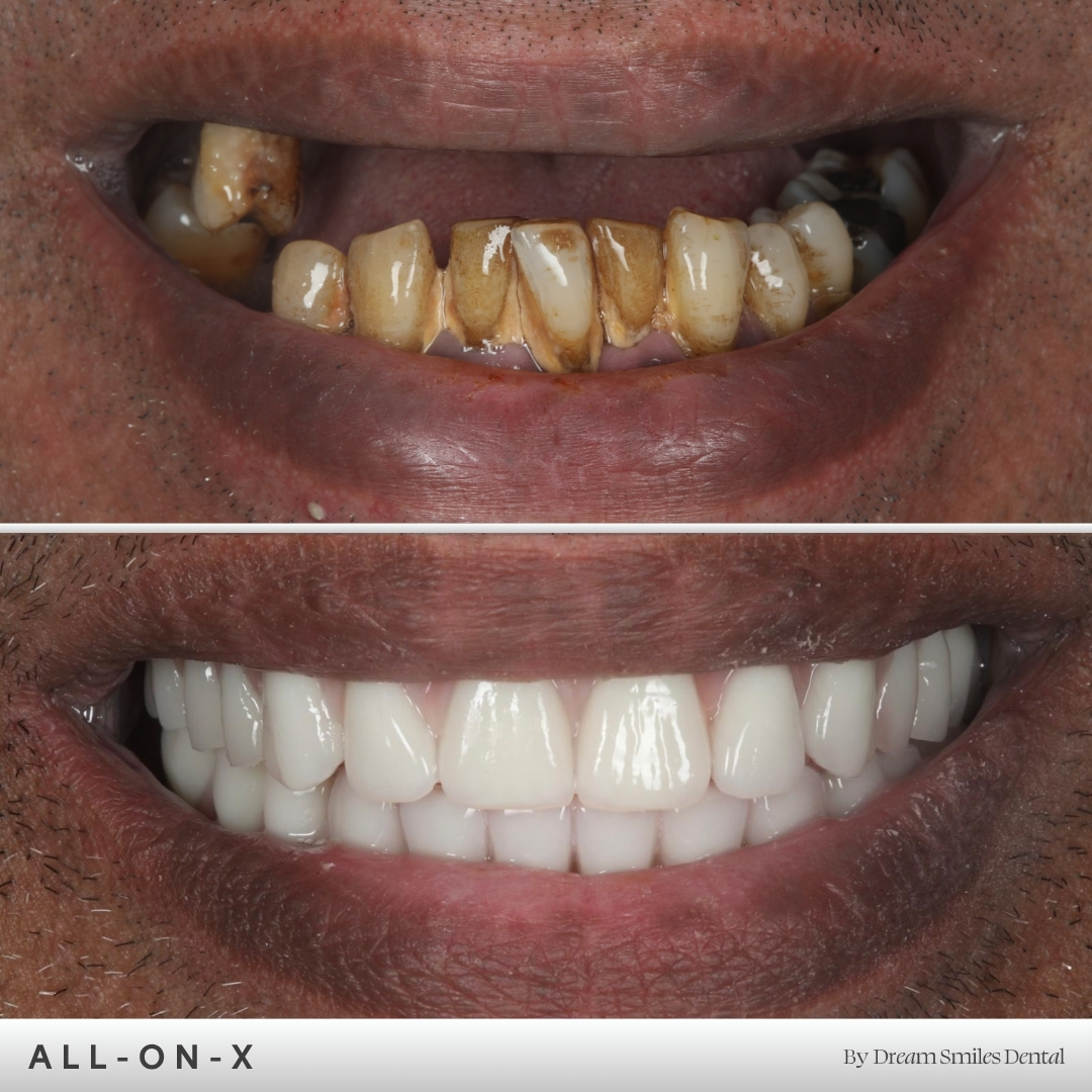 Full arch implant case, before and after