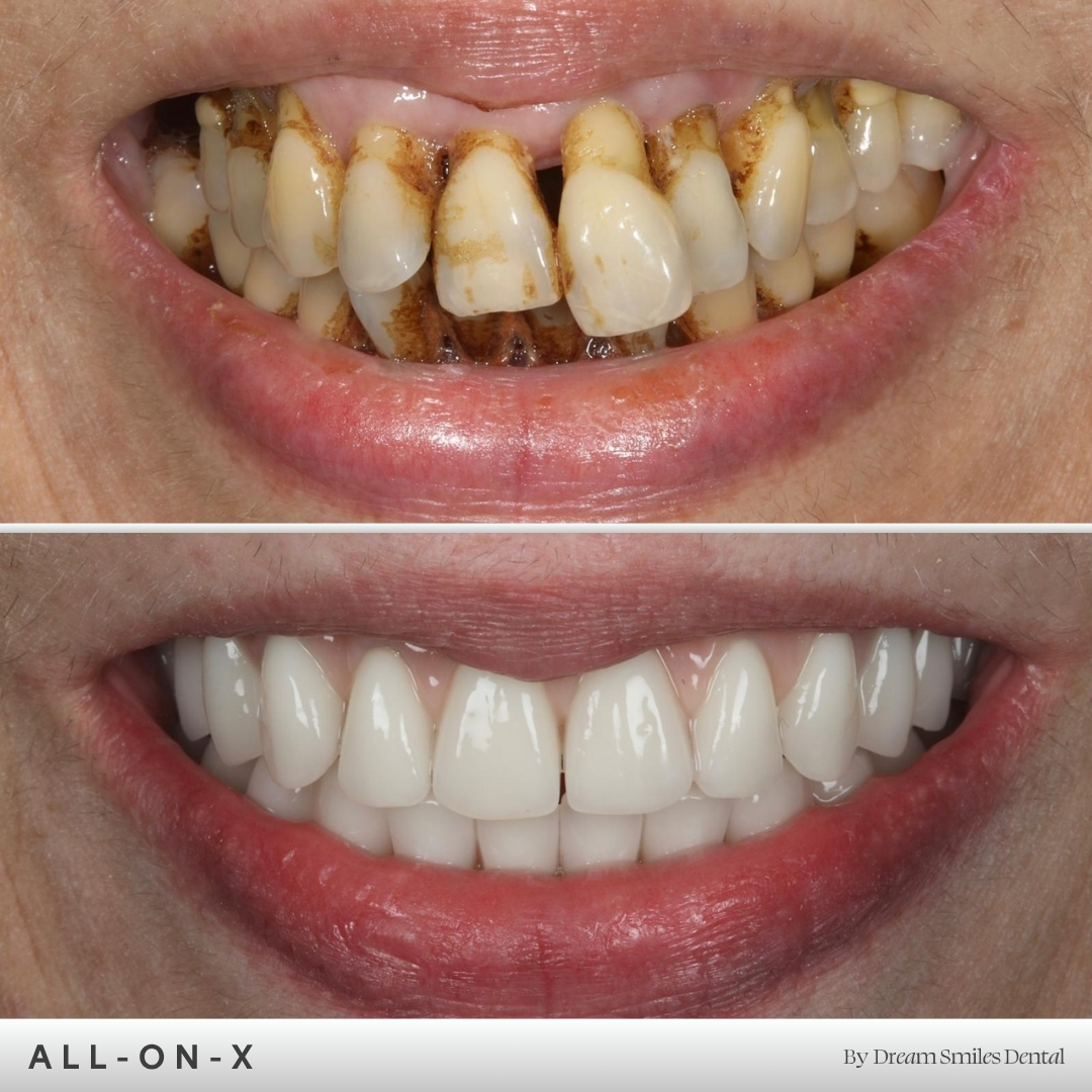 Full arch implant case, before and after