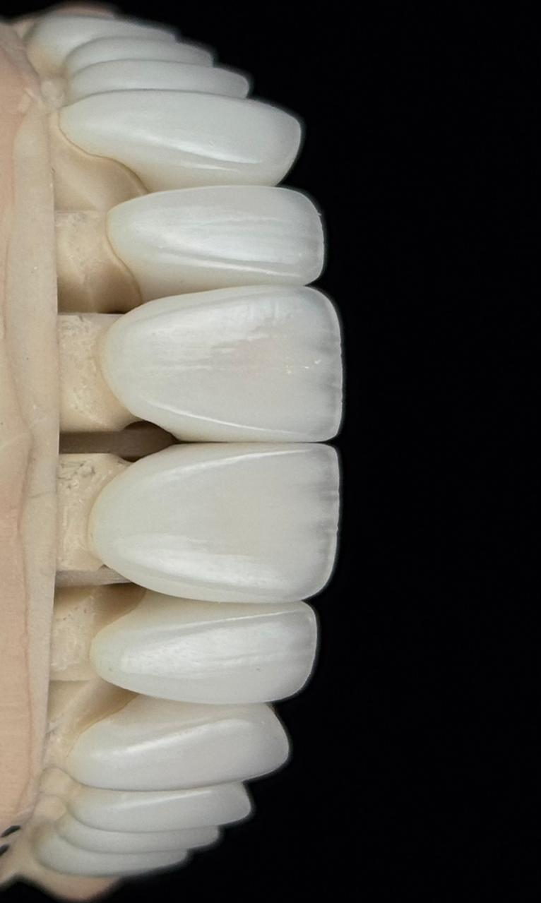 Porcelain Veneers