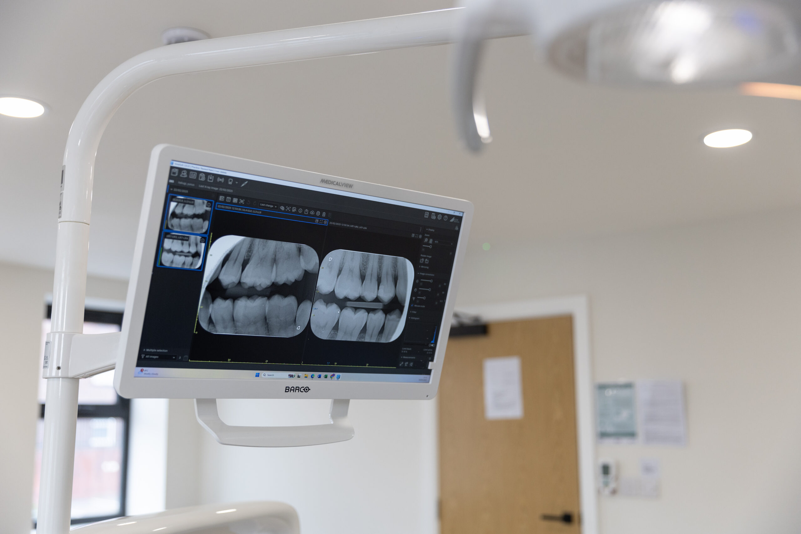 Root Canal Treatment