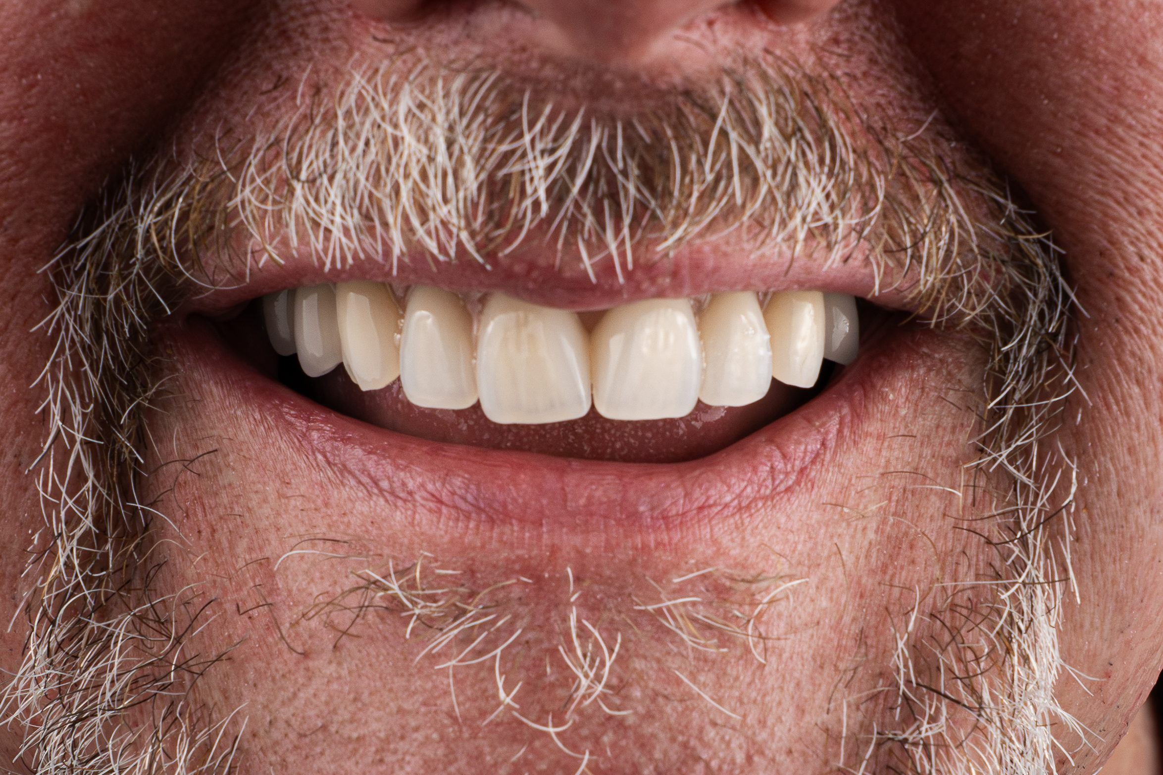 Dentures