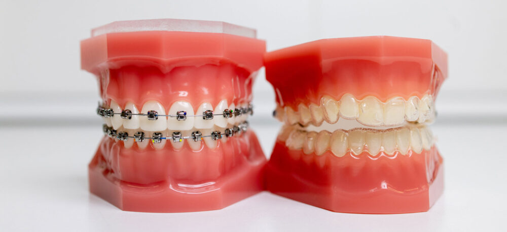 Side-by-Side Comparison of Invisalign and Braces