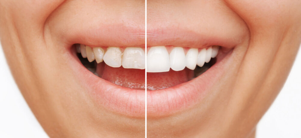 Before and After Composite Veneers