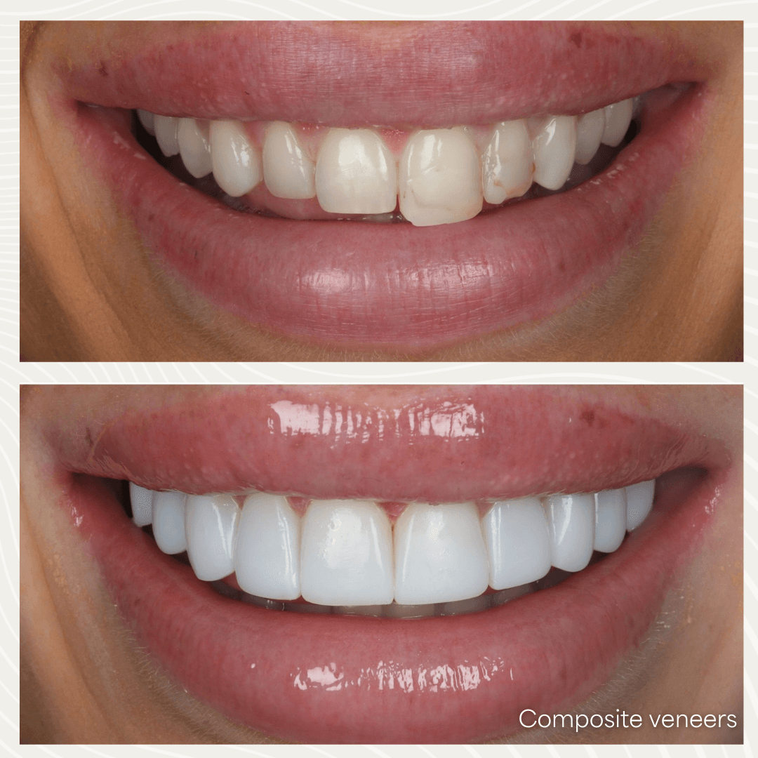 Close-up of a bright smile showing composite bonding results at Dream Smiles Dental in Bolton.