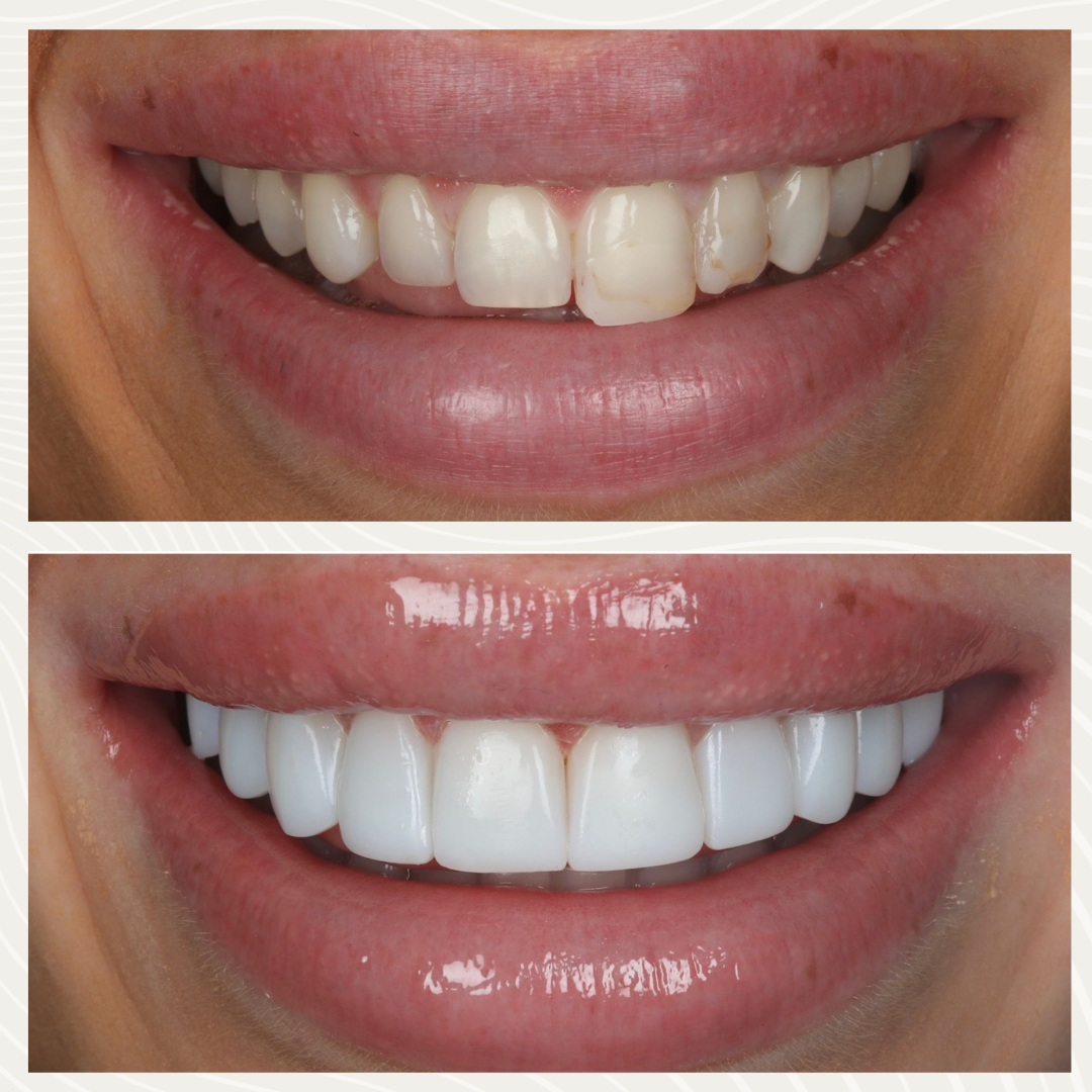 Before and after composite bonding