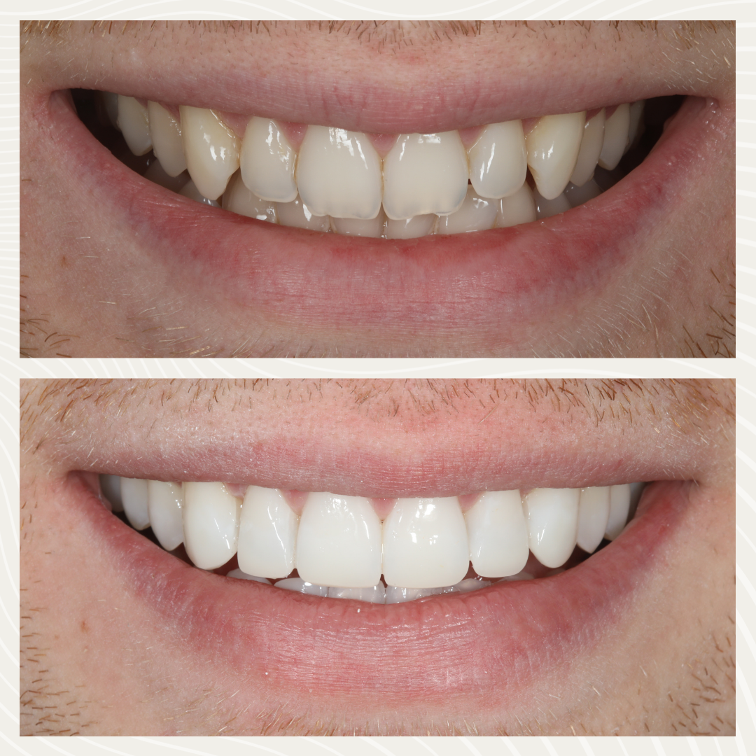 Before and after composite bonding