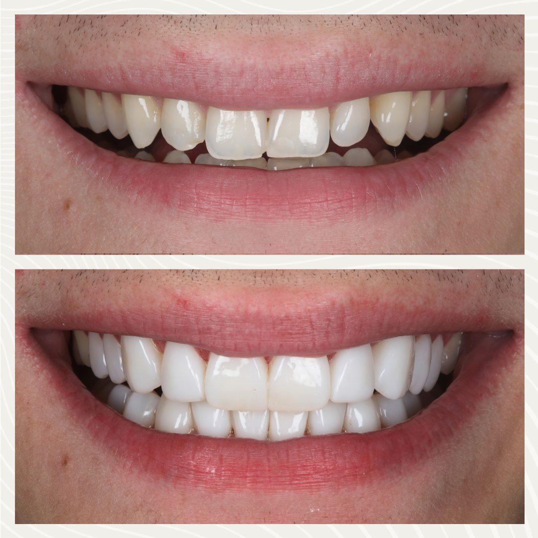 Before and after composite bonding