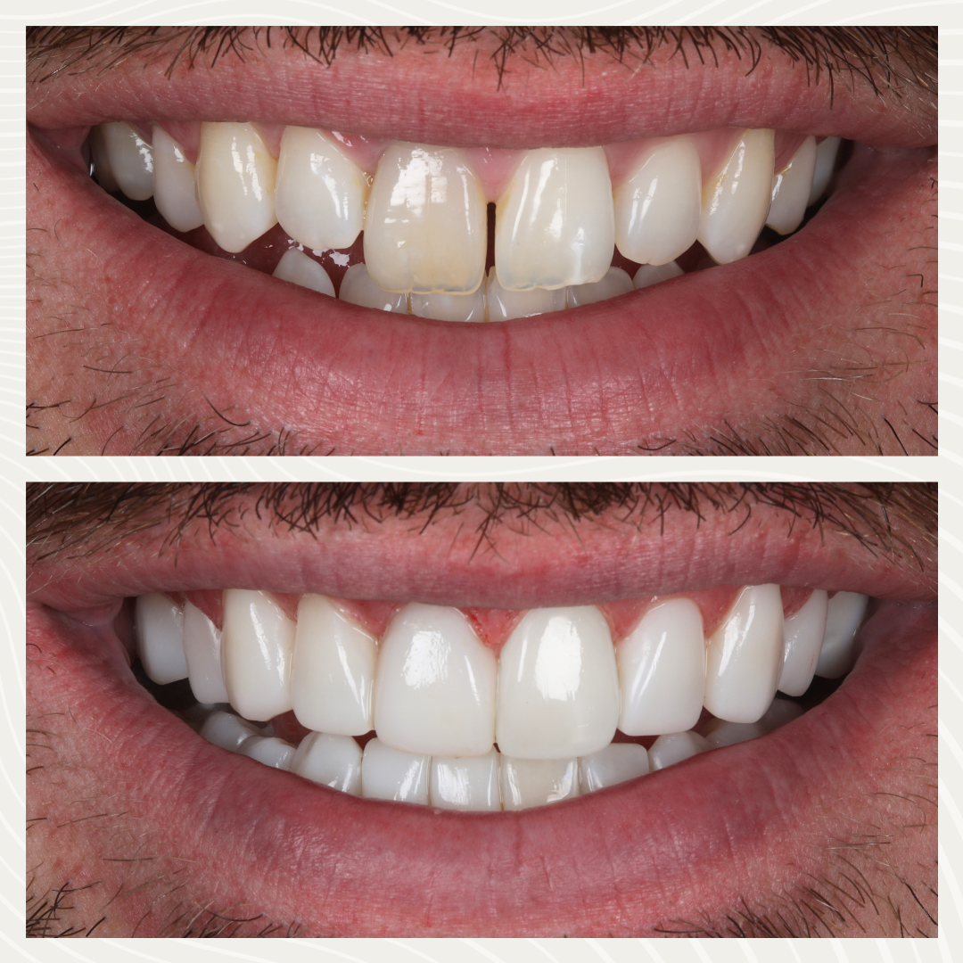 Before and after composite bonding