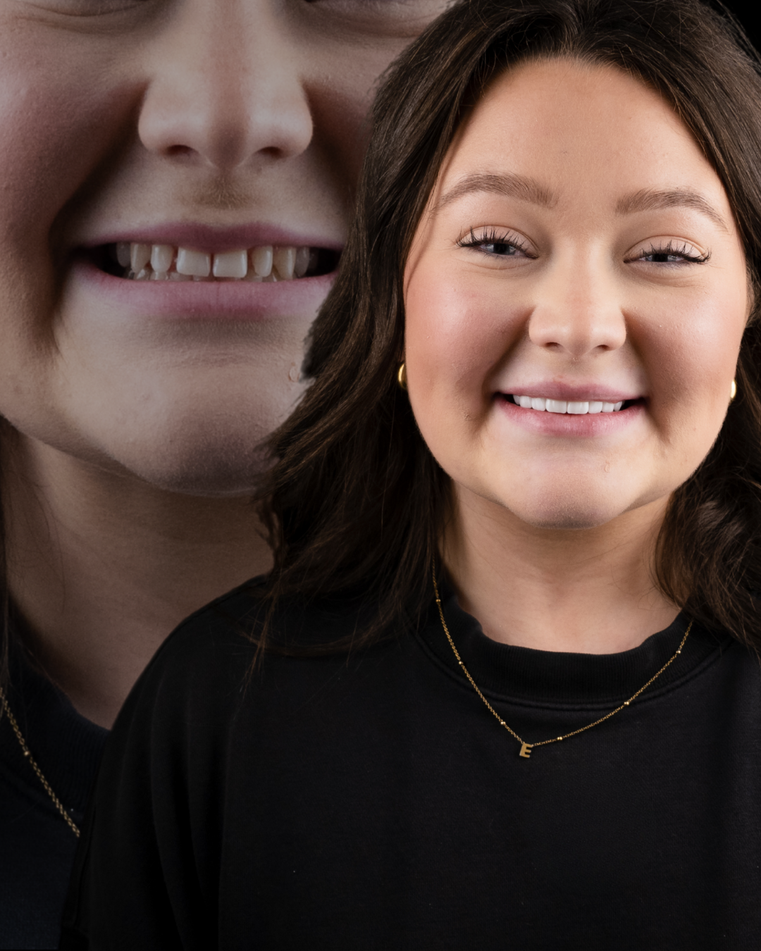 DreamVeneers case — finished result