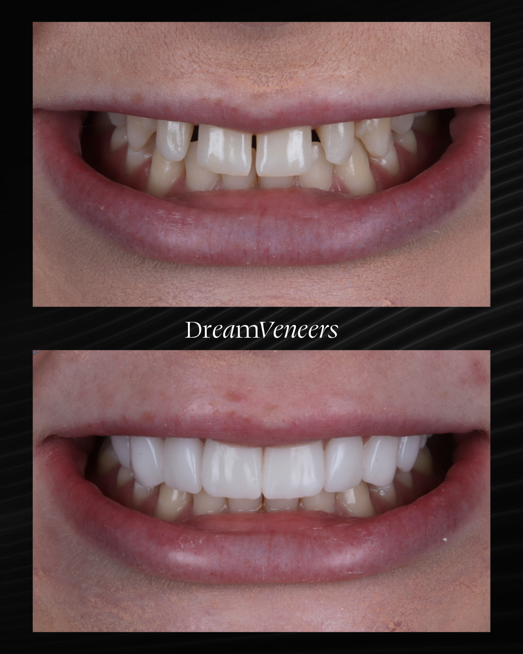 DreamVeneers case — smile transformation