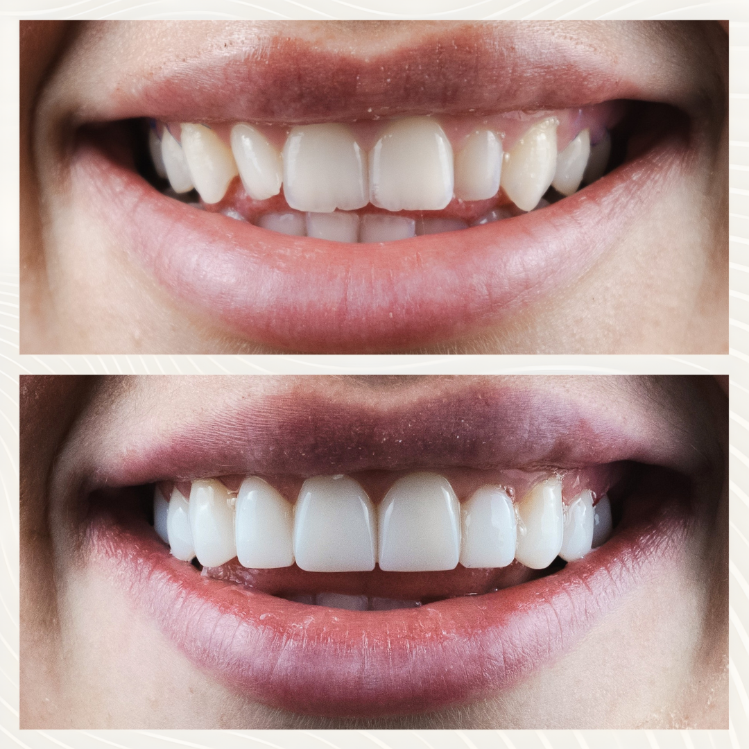 Before and after composite bonding