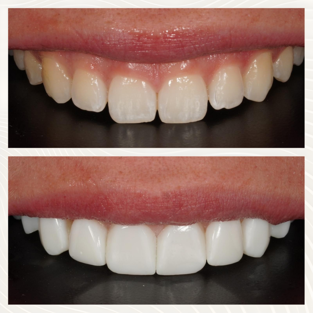 Before and after composite bonding
