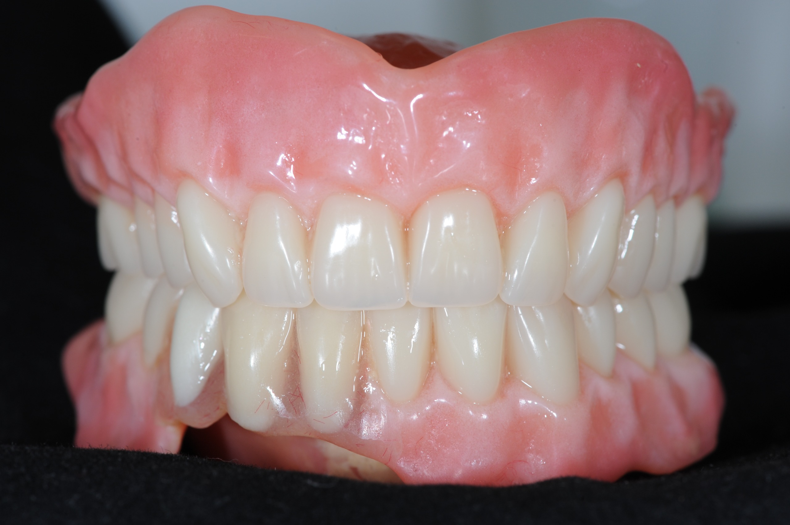 Standard conventional denture - before John