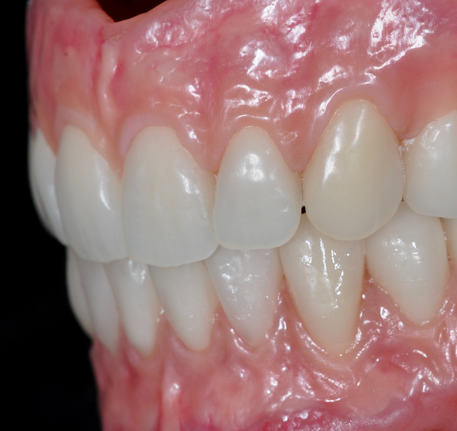 Denture result