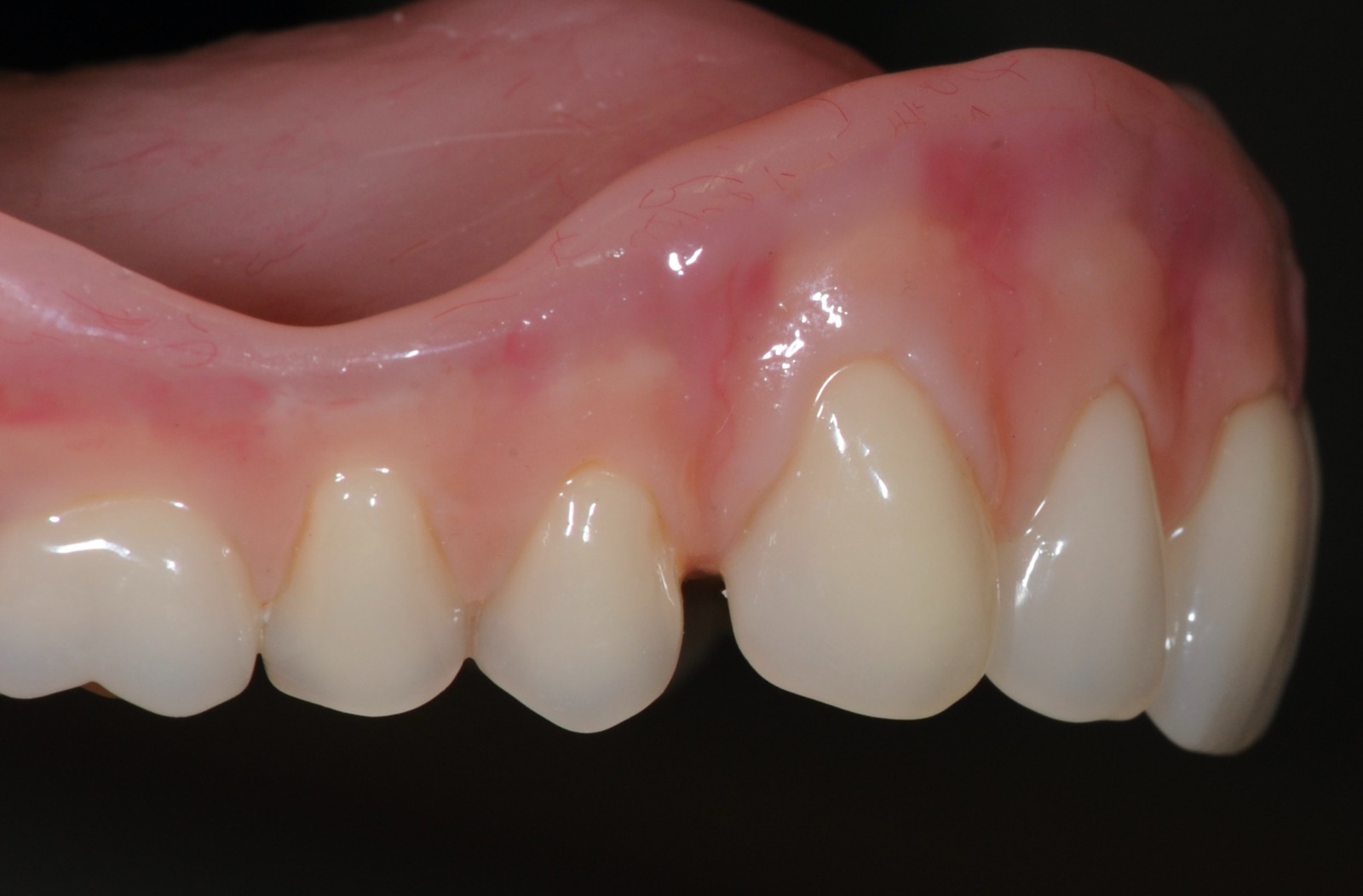 Denture result