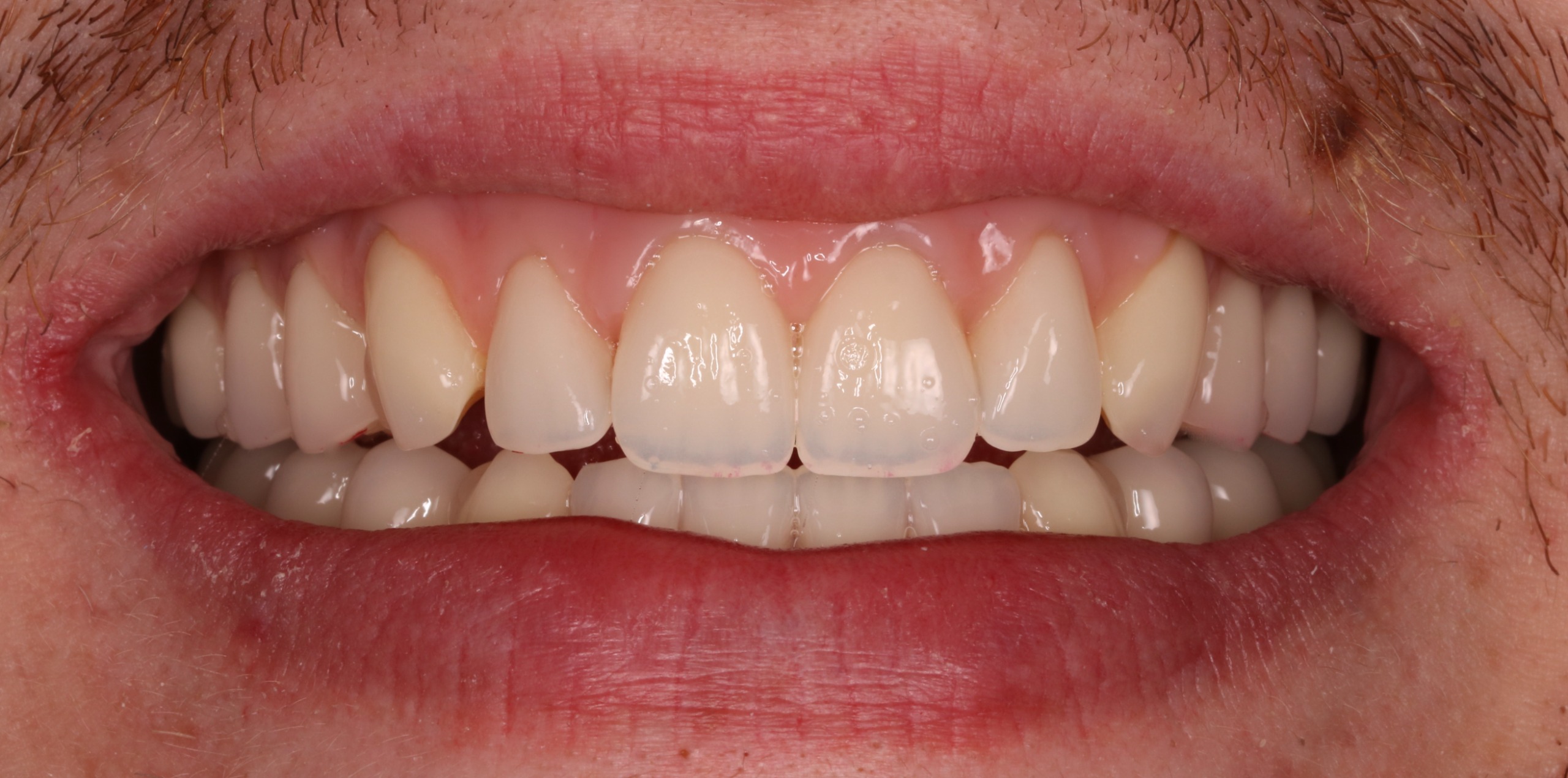 Suction denture fitting